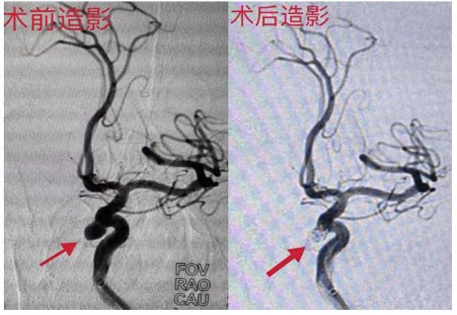“拆弹专家”巧用“支架+弹簧圈”颅内动脉瘤患者重获新生(图1)