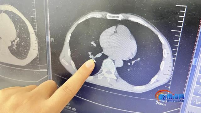 海口一男子睡梦中虫子钻进鼻腔被呛到气管！医生：是蟑螂(图1)