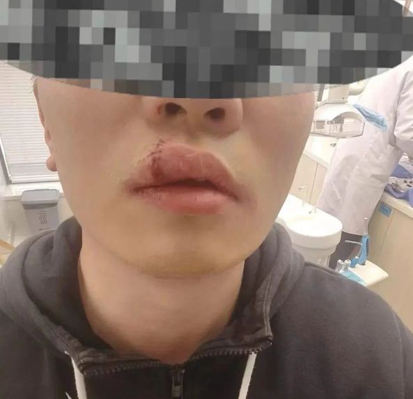 车主充电拔枪被“打脸”缝8针小鹏汽车：已提供必要关怀。(图1)